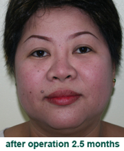 plastic_surgery_augmentation_rhinoplasty